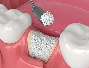 Illustration of granular bone graft at site of missing tooth