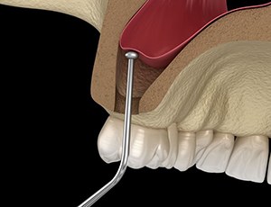 Illustration showing part of sinus lift procedure