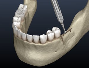 Illustration showing part of ridge expansion surgery