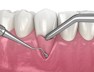 Illustration showing gum graft procedure