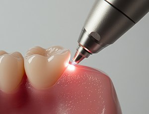 Illustration of dental laser being used on gum tissue