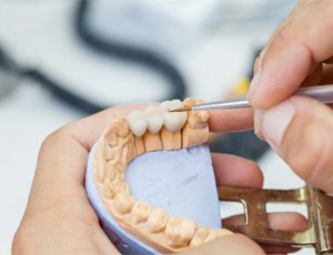 closeup of traditional dental bridge in Richardson