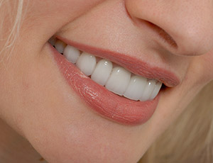Closeup of woman's flawless smile after dental bonding