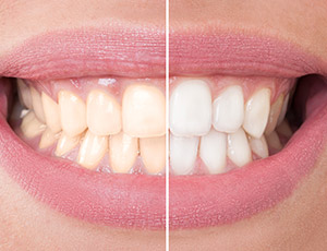 Closeup smile half before and half after teeth whitening