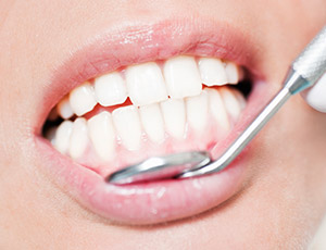 Closeup of flawless smile after gum recontouring