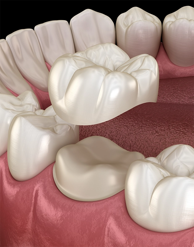 Illustration of a dental crown being placed over a tooth