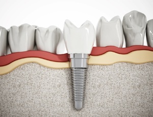 single dental implant post in the jaw