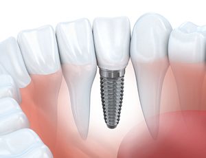 dental implant post in the jaw