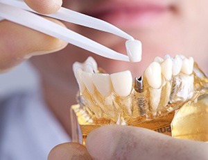 dentist placing a crown on a dental implant