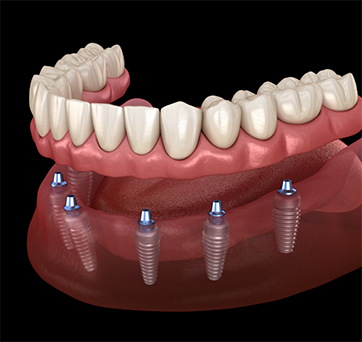 Illustration of an implant denture on the lower arch