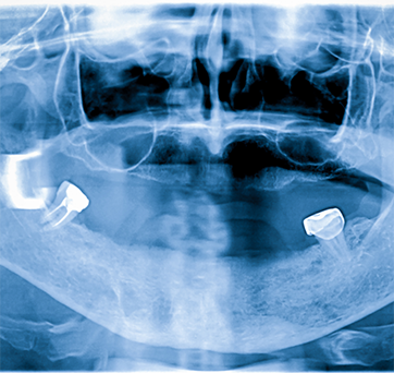 X-ray of a person with only two natural teeth