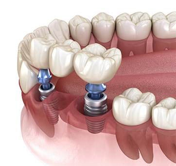 Illustration of a dental implant bridge