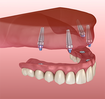 Illustration of an implant denture