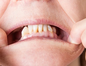 A close-up of a mouth with missing back teeth