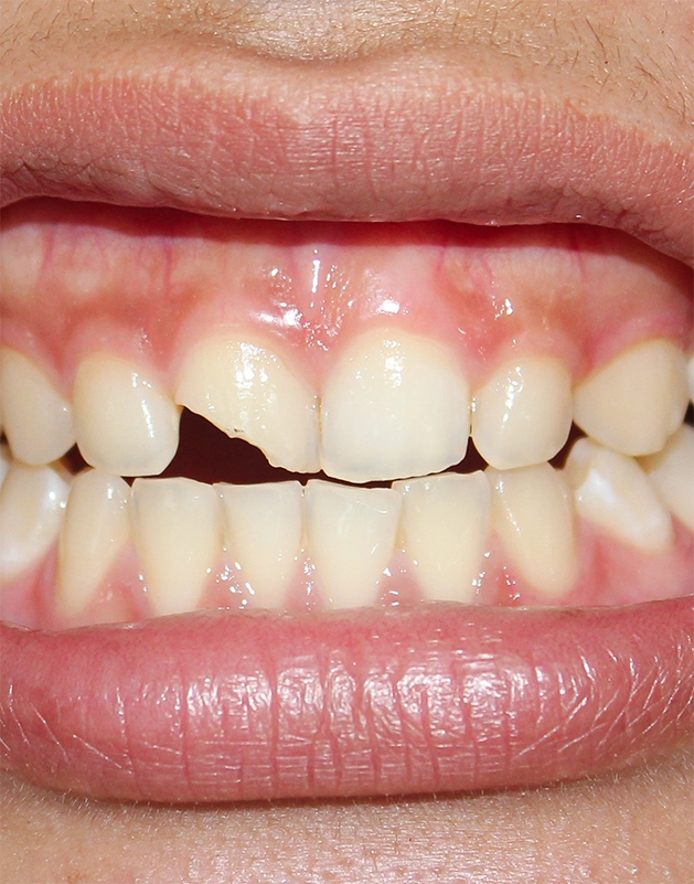 Close up of a chipped front tooth