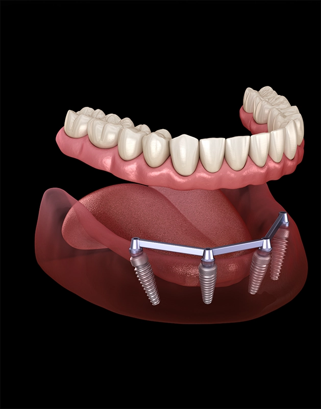 Illustration of an implant denture