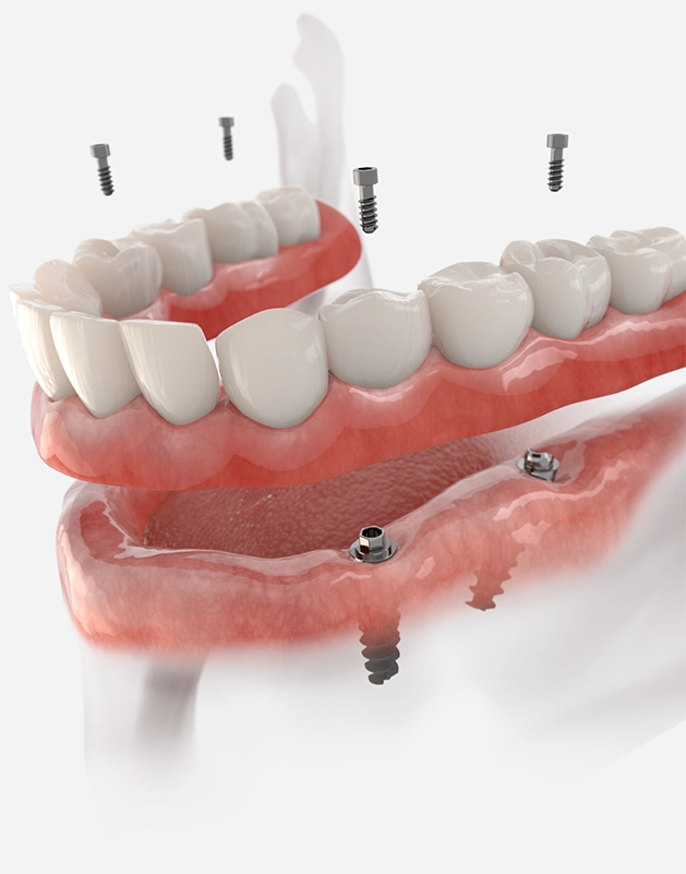 Model of an implant denture being placed