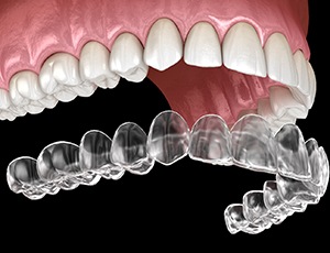 Invisalign aligner in Richardson