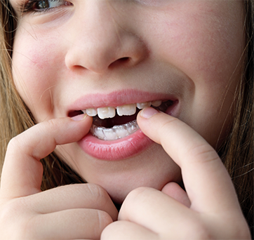 Teenager pointing to the aligner over their teeth