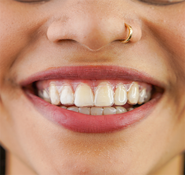Close up of a person smiling with clear aligners over their teeth