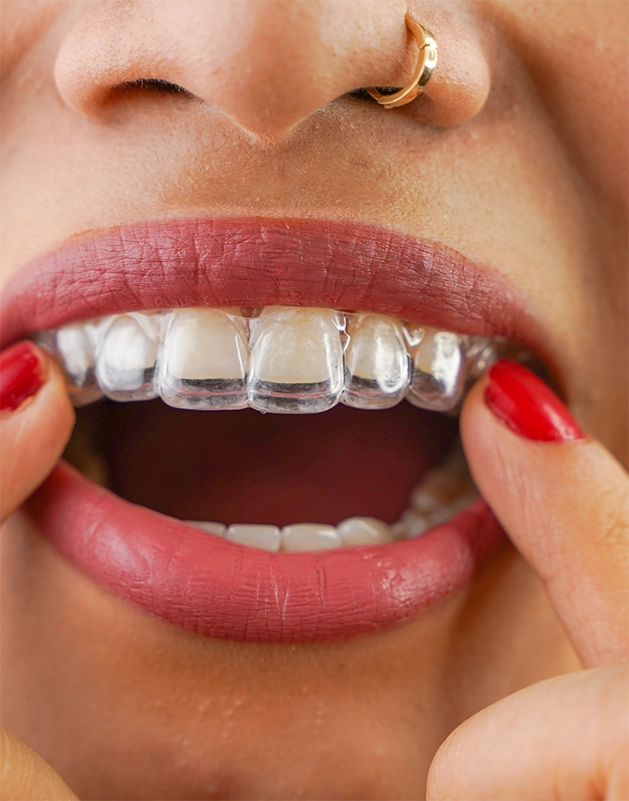 Close up of a person pointing to the clear aligner over their teeth