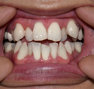 Close up of crowded teeth