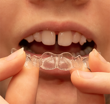 Close up of gapped teeth