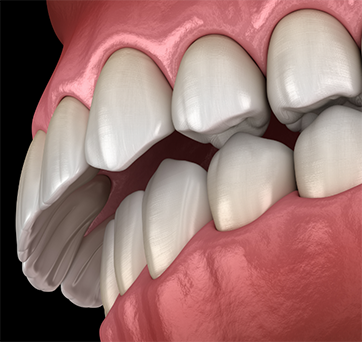 Illustrated overbite