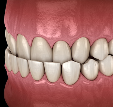 Illustrated underbite