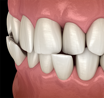 Illustrated crossbite