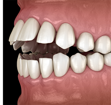 Illustrated open bite