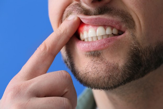 Man pulling lip up to reveal red, swollen gums
