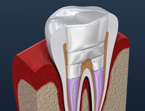 Animated inside of a tooth after root canal therapy