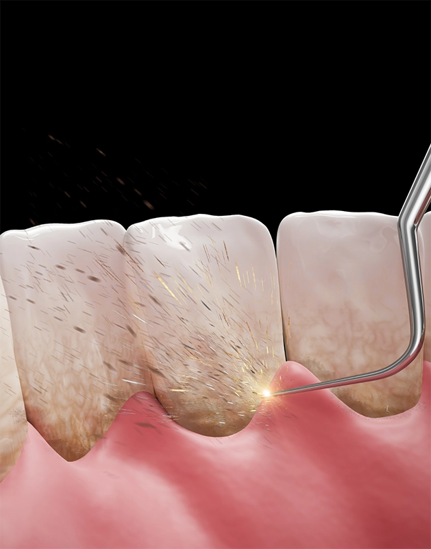 Illustration of the gums being treated with a dental scaler