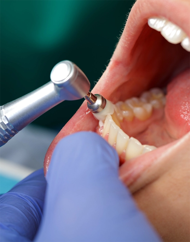 Dental patient getting their teeth polished