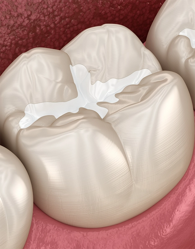 Illustration of a tooth with a sealant