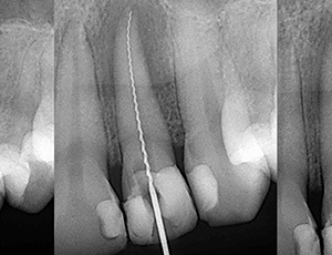 X-rays of teeth during root canal