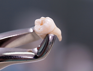 Metal clasps holding an extracted tooth