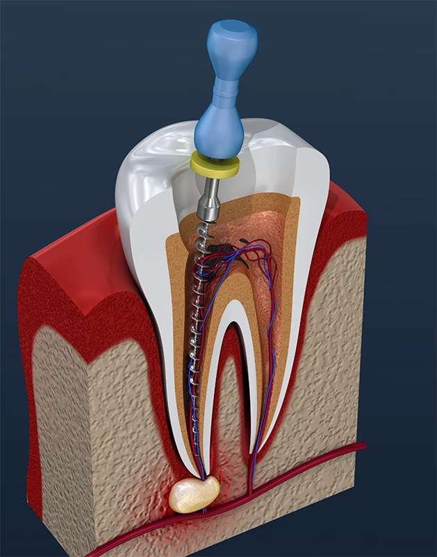 Illustration of a tooth getting a root canal