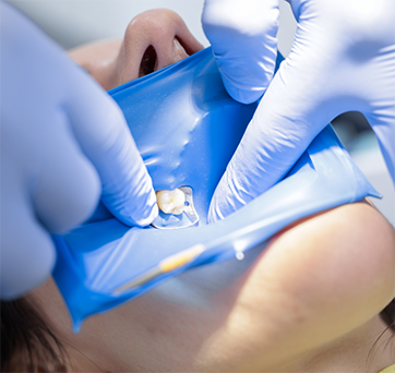 Dental patient undergoing root canal treatment