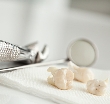Three extracted teeth on a gauze pad
