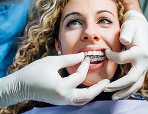 A woman inserting a SureSmile clear aligner