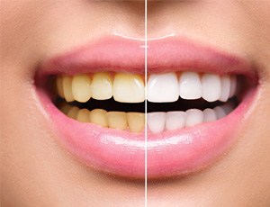 Before and after of teeth whitening treatment