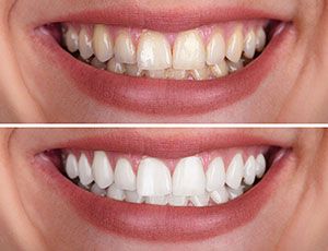 a closeup of a smile in Richardson before and after receiving teeth whitening