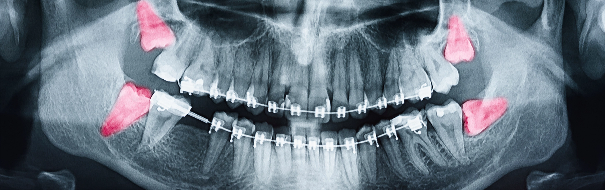 X-ray of a mouth with four impacted wisdom teeth