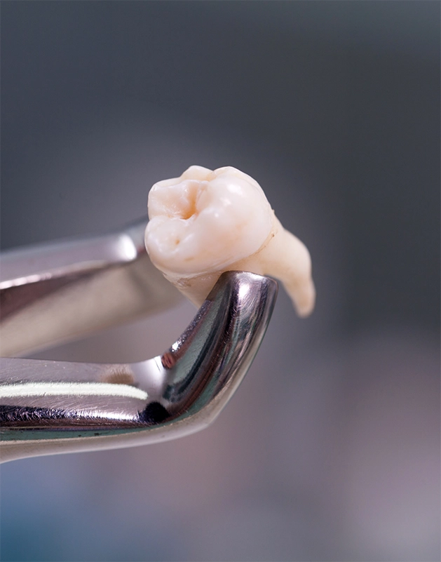 Dental forceps holding an extracted tooth