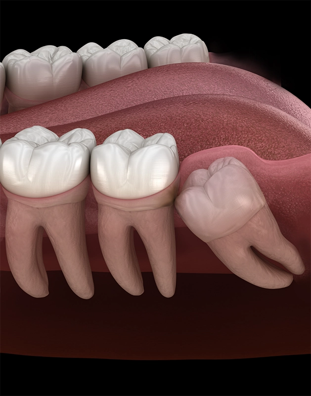 Illustration of an impacted wisdom tooth