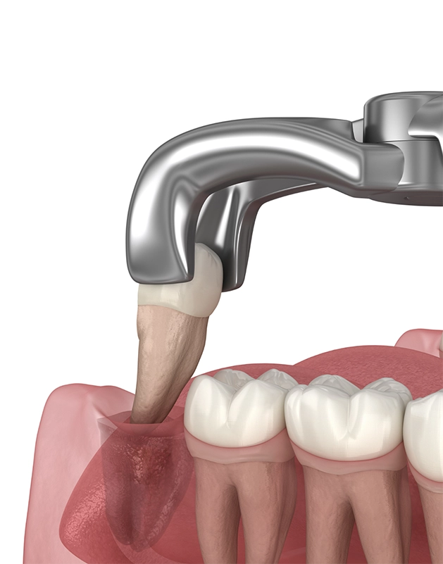Illustration of dental forceps removing a wisdom tooth