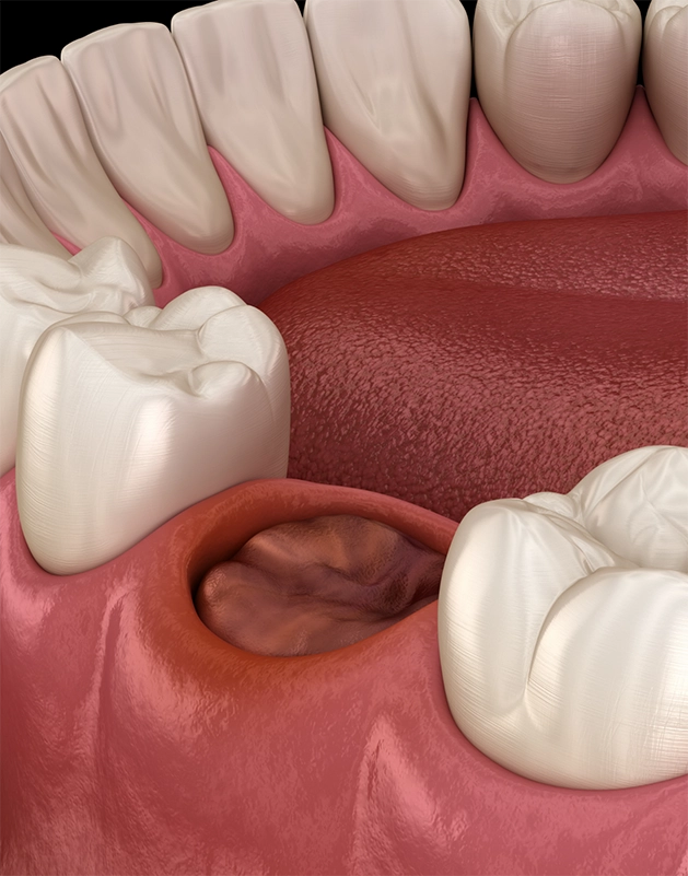 Illustration of an empty socket after tooth extraction