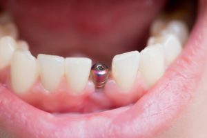 mouth open with dental implant